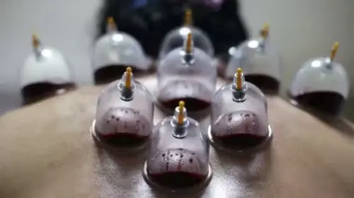 A side-by-side view of Dry Cupping and Wet Cupping (Hijama) cups on a patient back, showing the comparison.