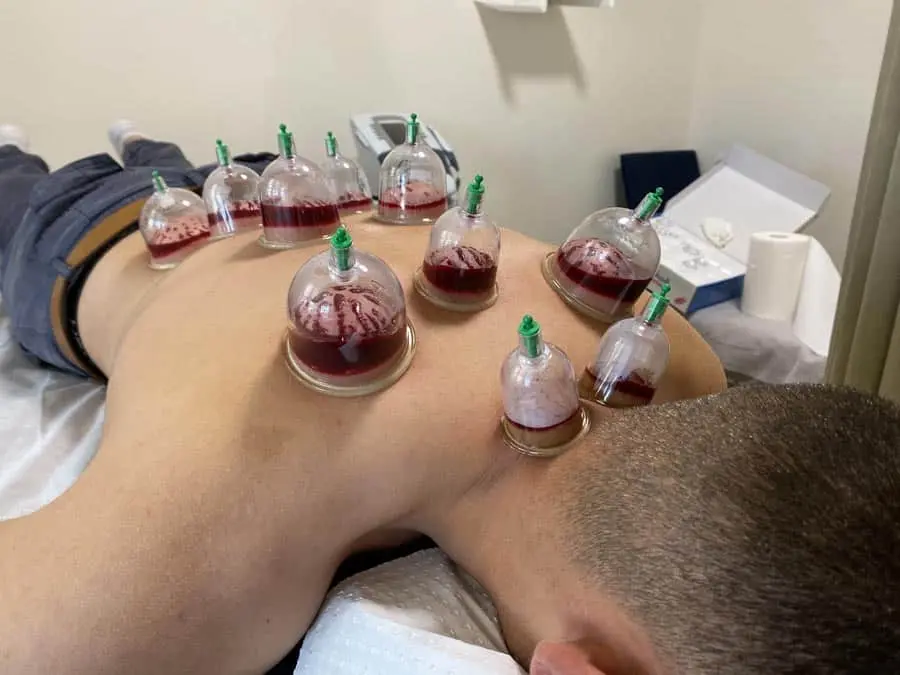 Hijama cupping therapy showing cups on a back in a clean, serene setting